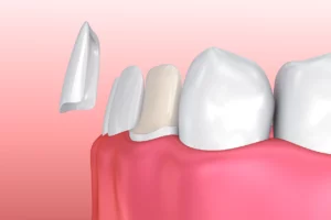 Dental Veneers Process: What is Involved and How Long Does It Take