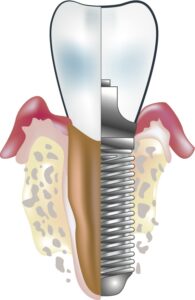 3 stages of dental implant